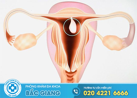 Hình ảnh polyp cổ tử cung