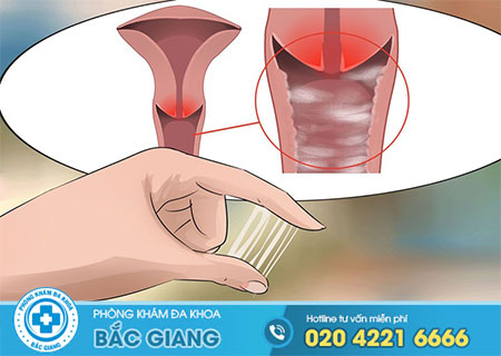 Khí hư ra nhiều và ngứa cảnh báo bệnh gì?