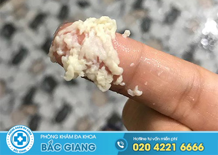 Khí hư ra nhiều vón cục là dấu hiệu của bệnh nào?