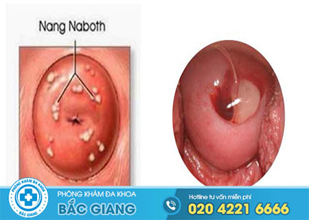 Hiểu đúng bệnh nang naboth cổ tử cung