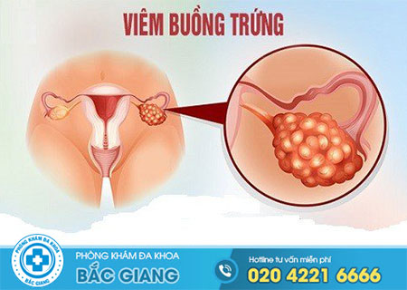 Nguyên nhân bị viêm buồng trứng