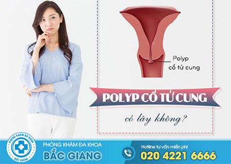 Polyp cổ tử cung có lây không?