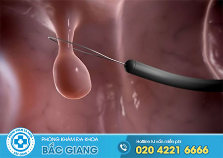 Polyp cổ tử cung gây chảy máu nhiều hay ít?