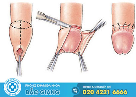 Quy trình cắt dài bao quy đầu