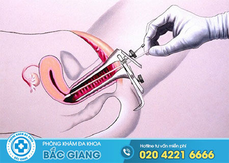 Sinh thiết polyp cổ tử cung có cần thiết không?