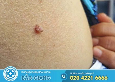 Sùi mào gà giai đoạn đầu có chữa được không?