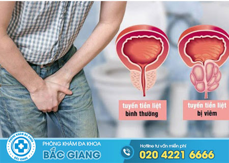 Vì sao bệnh viêm tiền liệt tuyến dễ tái phát