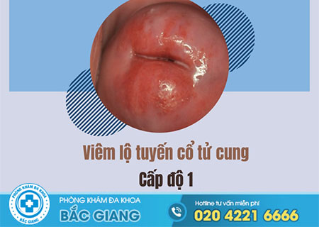 Tìm hiểu viêm lộ tuyến độ 1