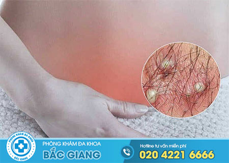 Viêm lông vùng kín và những điều cần biết