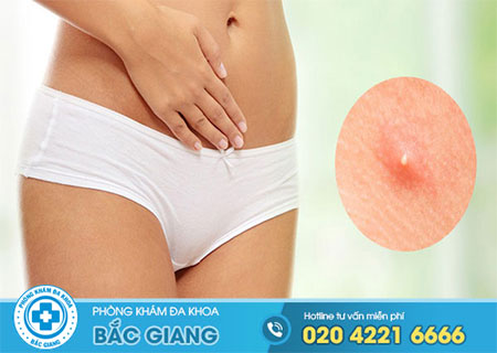 Vùng kín nổi mụn và ra nhiều khí hư nguyên nhân do đâu?