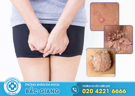 Biểu hiện sùi mào gà ở nữ