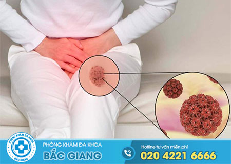 Sùi mào gà bộ phận sinh dục nữ