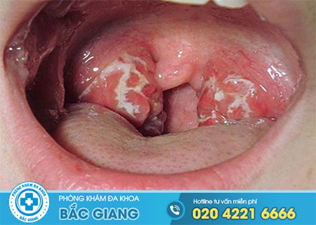 Bệnh lậu có lây qua nước bọt không?