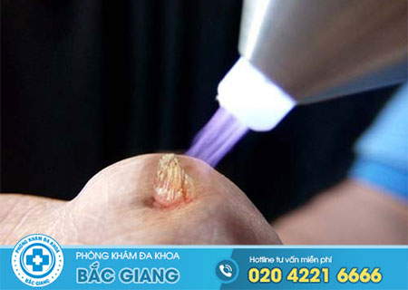 Đốt sùi mào gà bao lâu thì quan hệ được?