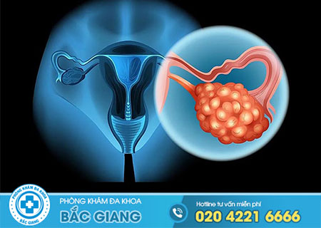 Mổ u nang buồng trứng kiêng ăn gì?