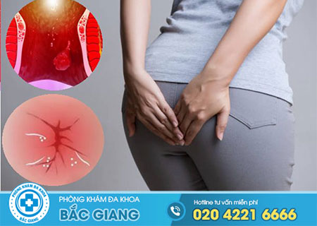 Mới bị trĩ phải làm sao?