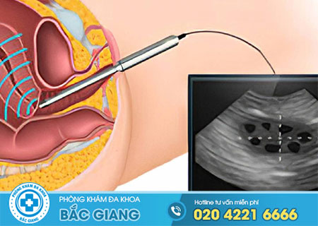 Siêu âm u nang buồng trứng