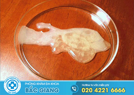 Tinh trùng vón cục là bệnh gì?