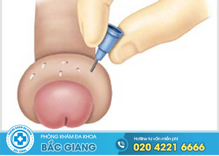 Bao quy đầu bị sưng mọng nước là bị sao?