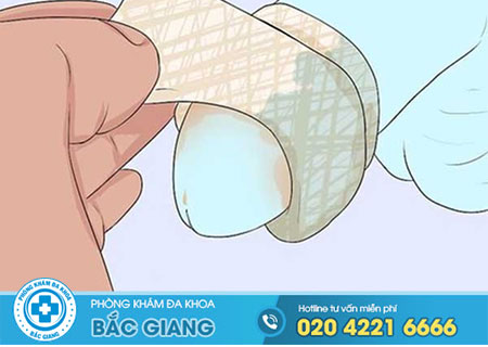  Cắt bao quy đầu bao lâu thì tháo băng?