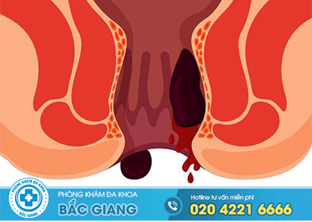 Cầm máu khi bị trĩ