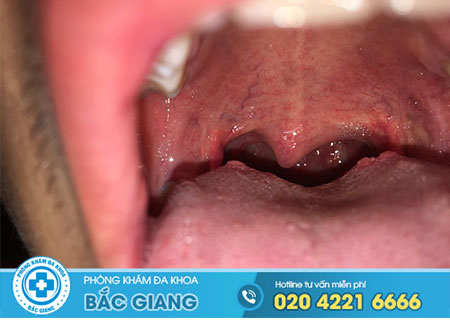Cuống lưỡi nổi mụn đỏ là bệnh gì?