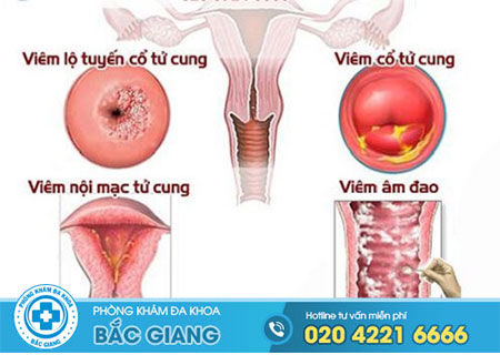 Những bệnh viêm phụ khoa thường gặp