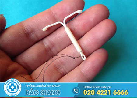 Đặt vòng tránh thai bao nhiêu tiền?