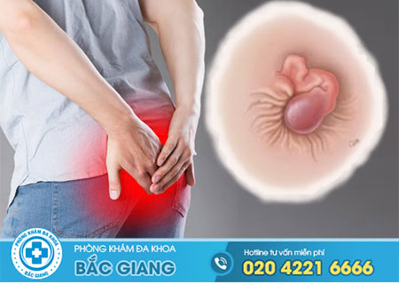 Bệnh trĩ không chữa có sao không?