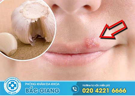 Cách điều trị mụn rộp sinh dục tại nhà